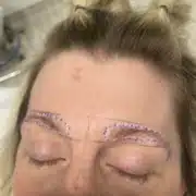 eyebrow hair transplant via WAW system - Hair 4 Life Medical eyebrow transplant - Hair 4 Life - Dr. Kelemen