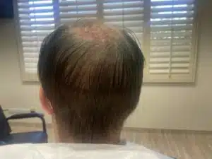 FUT Strip next day post op - Hair 4 Life Medical FUT Strip hair transplant - Hair 4 Life - Dr. Kelemen