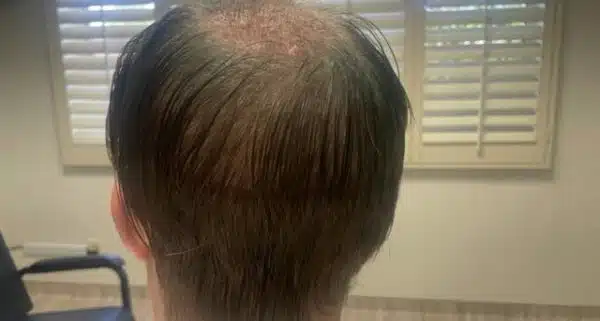 FUT Strip next day post op - Hair 4 Life Medical FUT Strip hair transplant - Hair 4 Life - Dr. Kelemen