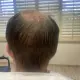 FUT Strip next day post op - Hair 4 Life Medical FUT Strip hair transplant - Hair 4 Life - Dr. Kelemen
