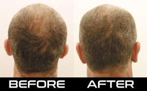 Injectable-Before-And-After - Hair 4 Life Medical Hair 4 Life Medical - Dr. Kelemen