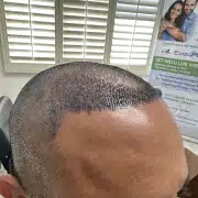 FUE hair transplant - Hair 4 Life - Dr. Kelemen 2 - Hair 4 Life Medical Hair 4 Life Medical - Dr. Kelemen