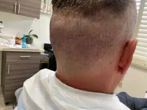 FUE hair transplant Donor area - Hair 4 Life Medical Hair 4 Life Medical - Dr. Kelemen