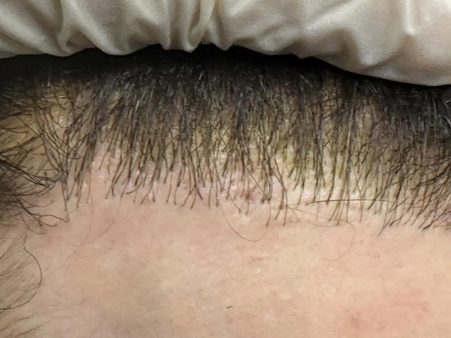 Before Corrective Surgery - Hair 4 Life Before Corrective Surgery - Hair 4 Life