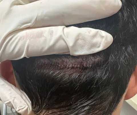 Scar Revision by Dr. Kelemen Scar Revision by Dr. Kelemen