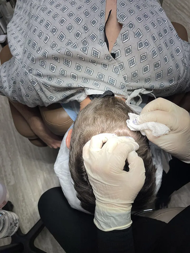 BHT - Body Hair Transplant 1 BHT - Body Hair Transplant 1