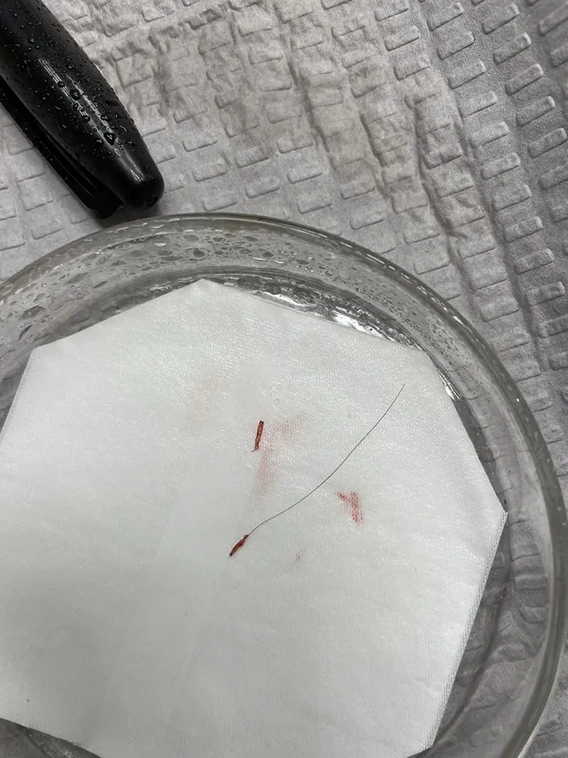 BHT - Body Hair Transplant 2 BHT - Body Hair Transplant 1