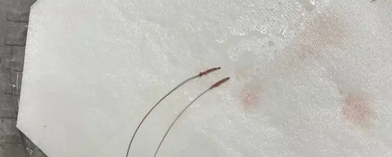 BHT - Body Hair Transplant 1