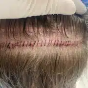 FUTStrip2-600x450 - Hair 4 Life Medical Hair 4 Life Medical - Dr. Kelemen