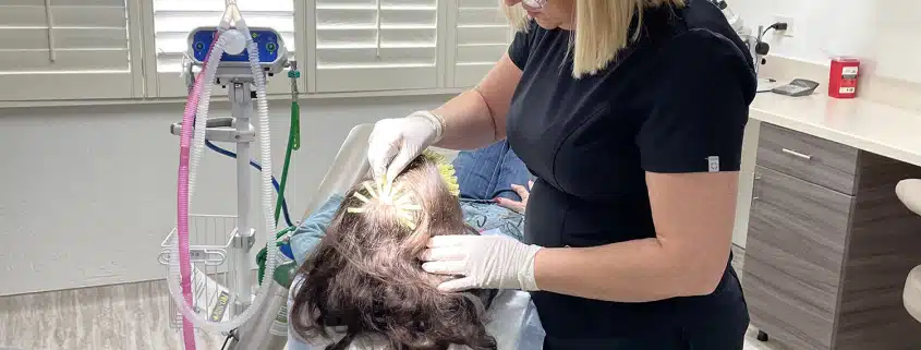 PDO Threads Hair Loss Treatment 1 - Hair 4 Life Medical Hair 4 Life Medical - Dr. Kelemen