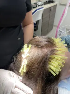 PDO Threads Hair Loss Treatment 2 - Hair 4 Life Medical Hair 4 Life Medical - Dr. Kelemen