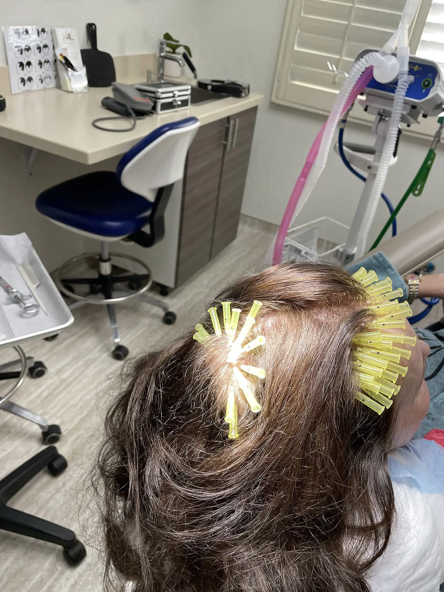 PDO Threads Hair Loss Treatment 4 Hair 4 Life Medical - Dr. Kelemen