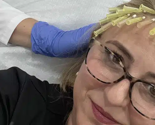 PDO Threads Hair Loss Treatment Hair 4 Life Medical - Dr. Kelemen