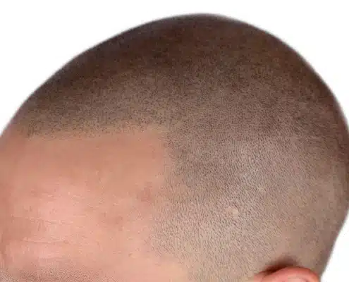 SMP - SCALP MICROPIGMENTATION copy Hair 4 Life Medical - Dr. Kelemen