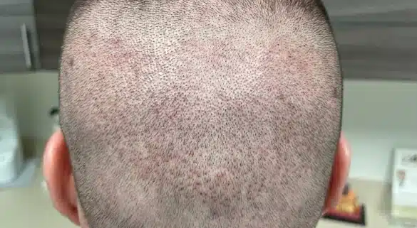 beard transplant 4 - Hair 4 Life Medical Hair 4 Life Medical - Dr. Kelemen