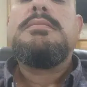 beard transplant 6 - Hair 4 Life Medical Hair 4 Life Medical - Dr. Kelemen