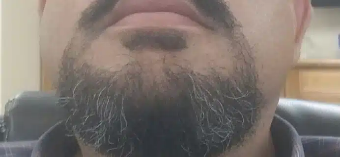 beard transplant 6 - Hair 4 Life Medical Hair 4 Life Medical - Dr. Kelemen