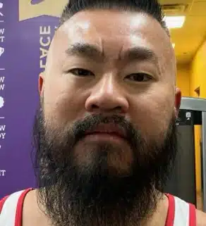 beard transplant 7 - Hair 4 Life Medical Hair 4 Life Medical - Dr. Kelemen