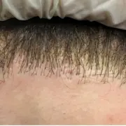 corrective hair transplant surgery - Hair 4 Life Medical corrective hair transplant surgery