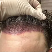 corrective hair transplant surgery 2 - Hair 4 Life Medical corrective hair transplant surgery