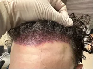 corrective hair transplant surgery 2 - Hair 4 Life Medical corrective hair transplant surgery