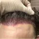 corrective hair transplant surgery
