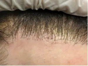 corrective hair transplant surgery - Hair 4 Life Medical corrective hair transplant surgery