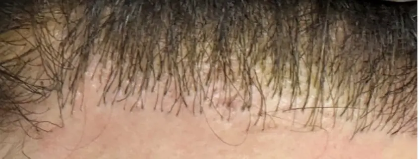 corrective hair transplant surgery