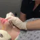 Beard hair transplant with Dr Kelemen