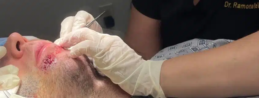 Beard Hair Transplant - Hair 4 Life Medical Beard hair transplant with Dr Kelemen