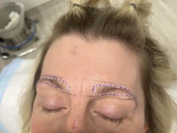 FUE eyebrow hair transplant - Dr Kelemen Eyebrow mapping