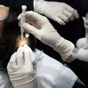 Hair,Transplantation,Process,,Pulling,Hair,Follicles,Back,And,Replanting,Them. - Hair 4 Life Medical No Shave FUE Hair Transplant