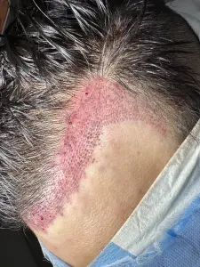 Hairline design by Dr Kelemen, Hair 4 Life Medical