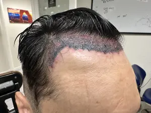 Dr Kelemen hairline - Hair 4 Life Medical Hairline with grafts in it with Dr Kelemen