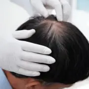 FUE on Crown - Hair 4 Life Medical FUE Crown Hair Transplant