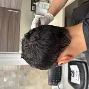 Dr Kelemen post op - Hair 4 Life Medical Dr Kelemen teaching the patient how to take care of their freshly transplanted hair and donor area.