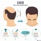 DHI - Hair 4 Life Medical DHI diagram
