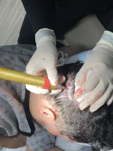 Dr Kelemen using WAW for No Shave FUE - Hair 4 Life Medical Dr Kelemen No Shave Fue