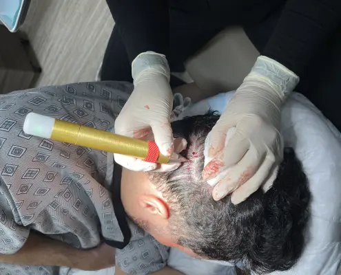 Dr Kelemen No Shave Fue