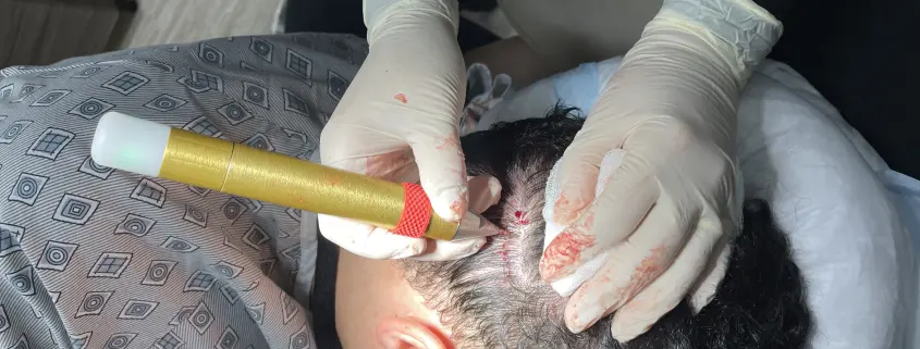 Dr Kelemen No Shave Fue