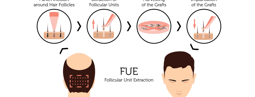 Hair-Transplant-FUE - Hair 4 Life Medical FUE hair transplant diagram