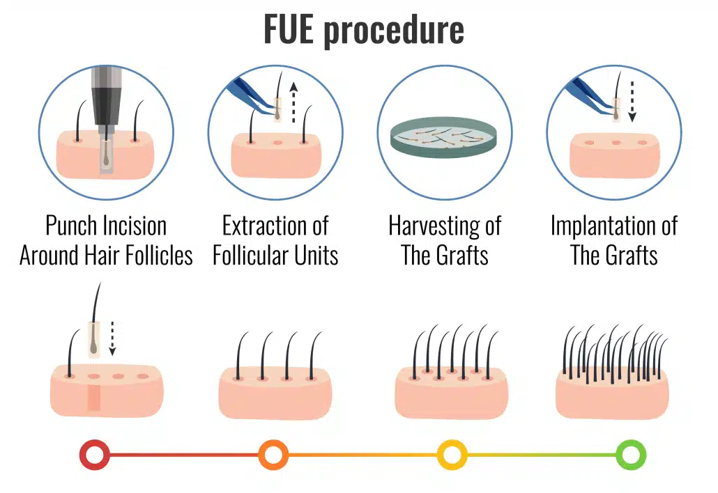 FUE procedure close-up steps: punch incision, extraction, harvesting, implantation