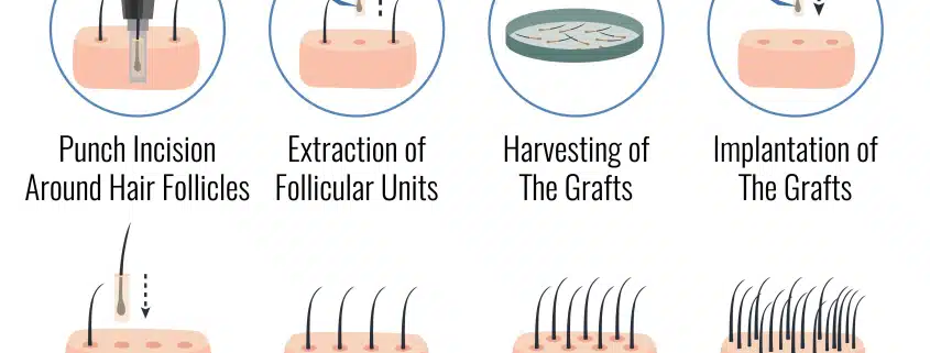 FUE procedure in detail