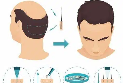 DHI hair transplant explanation