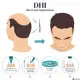 DHI hair transplant explanation