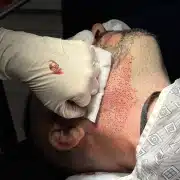 FUE hybrid - Hair 4 Life Medical Beard to scalp Hybrid