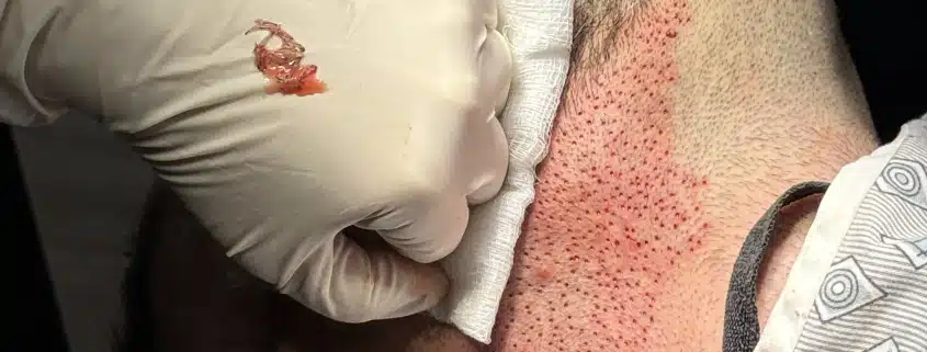 Beard to scalp Hybrid