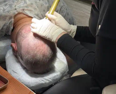 Hair-transplant with Dr Kelemen using the wireless WAW system