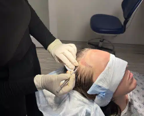 Dr Kelemen during FUE procedure: site making.