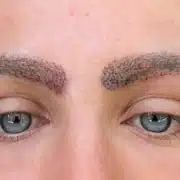Eyebrow hair transplant FUE - Hair 4 Life Medical Eyebrow hair transplant FUE